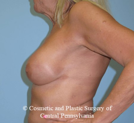 Breast Reconstruction After