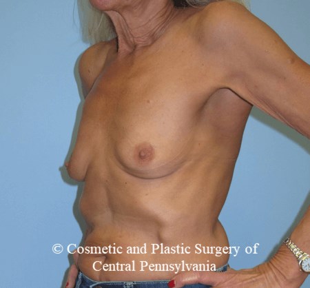 Breast Reconstruction Before