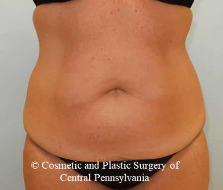 Tummy Tuck Before