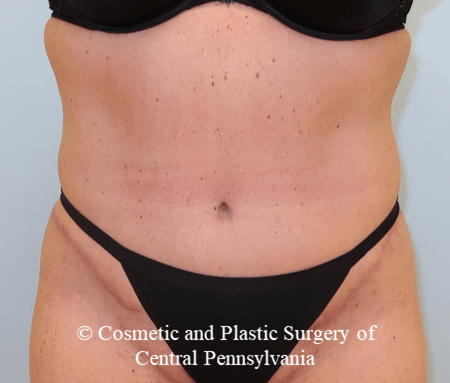 Tummy Tuck After