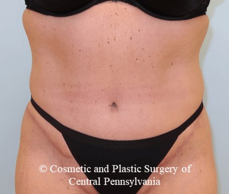 Tummy Tuck After