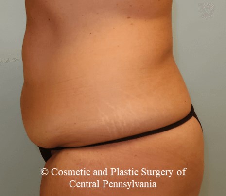 Tummy Tuck Before
