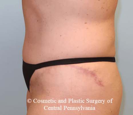 Tummy Tuck After