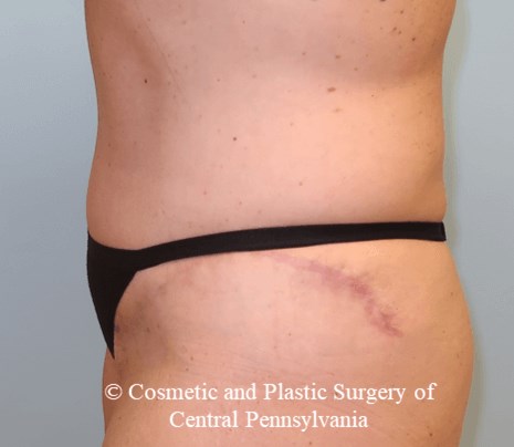 Tummy Tuck After