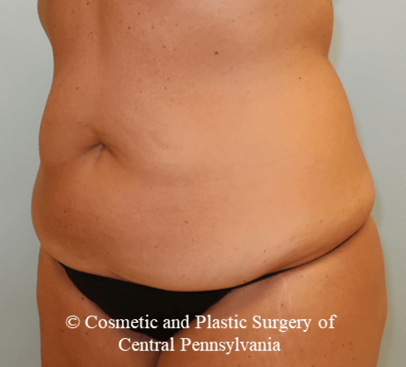 Tummy Tuck Before