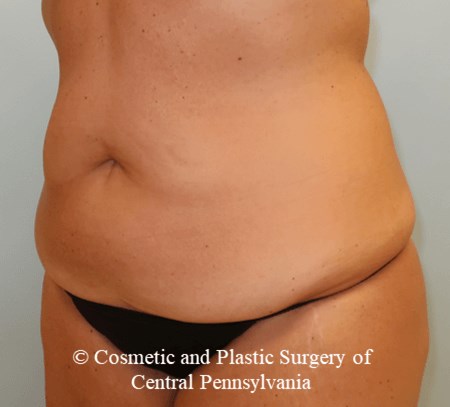 Tummy Tuck Before