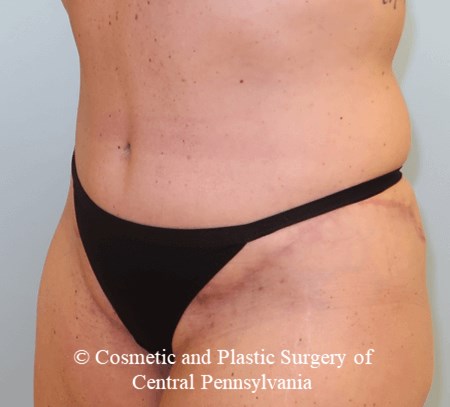 Tummy Tuck After