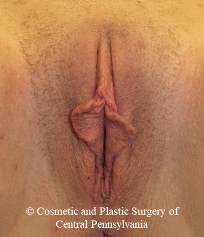 Labiaplasty Before