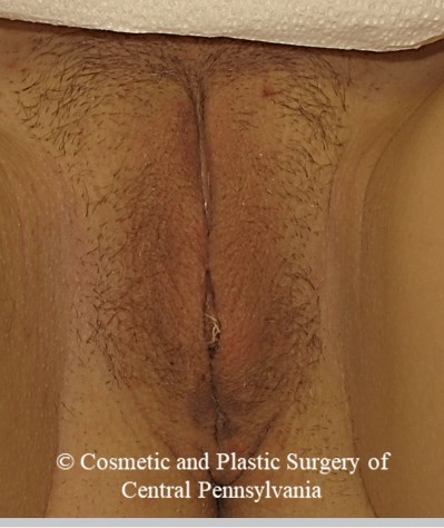 Labiaplasty After