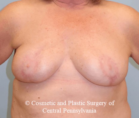 Breast Lift (Mastopexy) After
