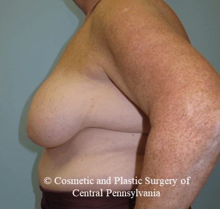 Breast Lift (Mastopexy) Before