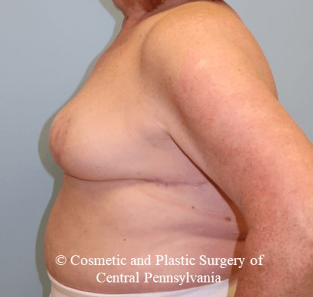 Breast Lift (Mastopexy) After