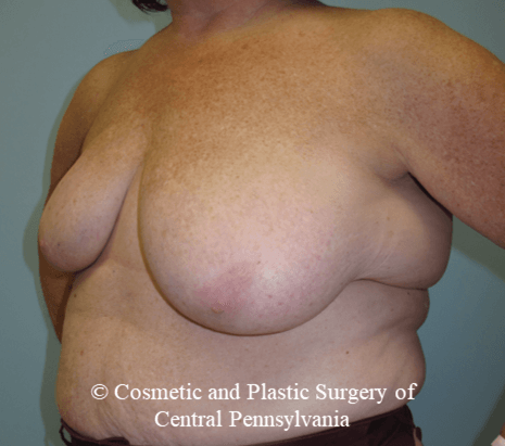 Breast Lift (Mastopexy) Before