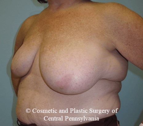 Breast Lift (Mastopexy) Before