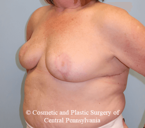 Breast Lift (Mastopexy) After