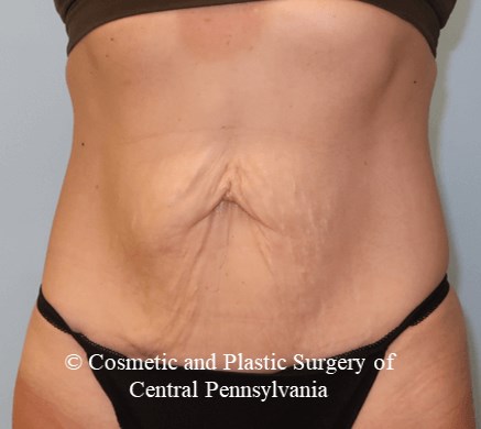 VelaShapeIII Abdomen Before