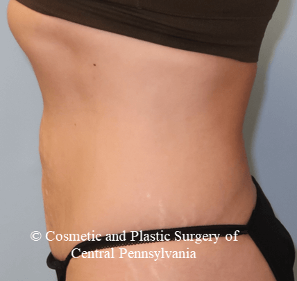 VelaShapeIII Abdomen Before