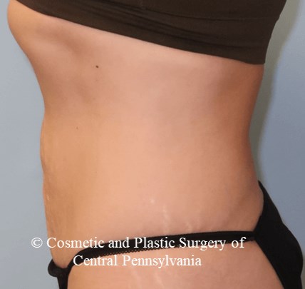 VelaShapeIII Abdomen Before