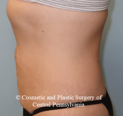 VelaShapeIII Abdomen After