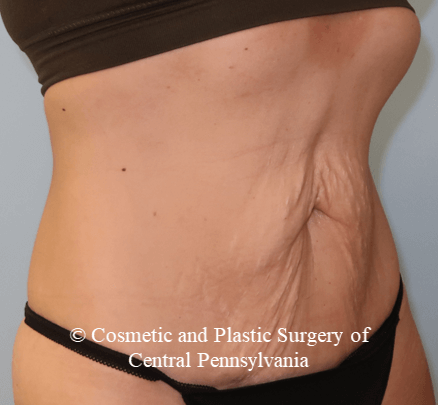 VelaShapeIII Abdomen Before