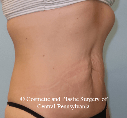 VelaShapeIII Abdomen After