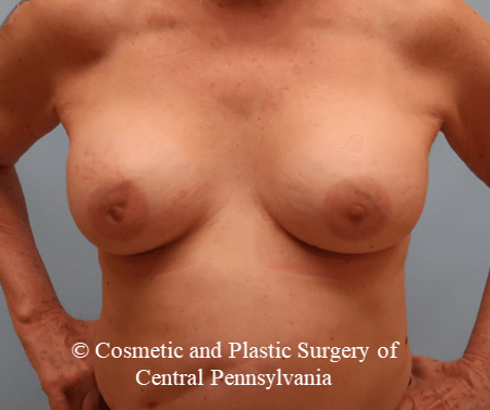 Breast Augmentation After
