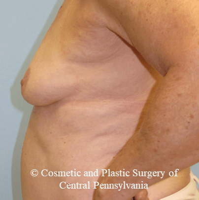 Breast Augmentation Before