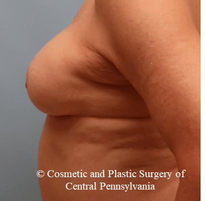 Breast Augmentation After