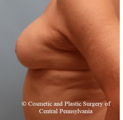 Breast Augmentation After