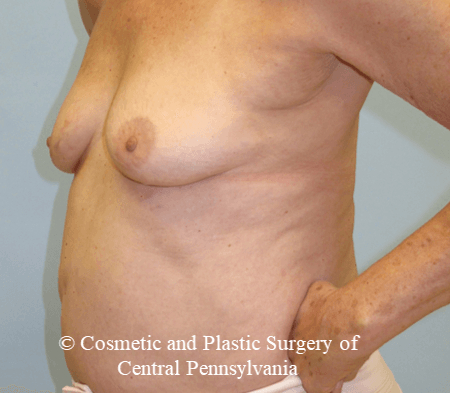 Breast Augmentation Before