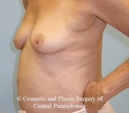 Breast Augmentation Before