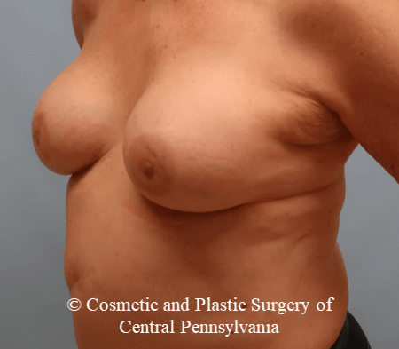 Breast Augmentation After