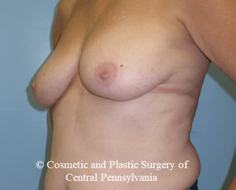 Breast Lift (Mastopexy) Before