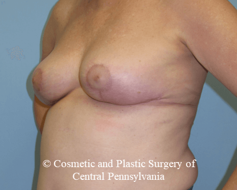 Breast Lift (Mastopexy) After