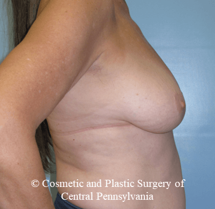 Breast Lift (Mastopexy) Before