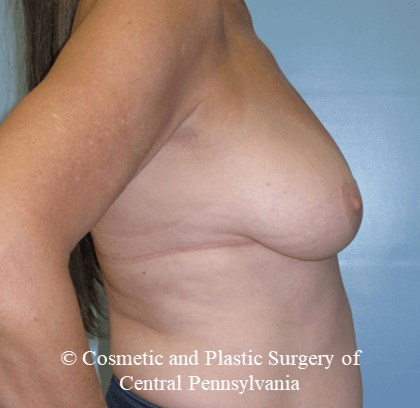 Breast Lift (Mastopexy) Before