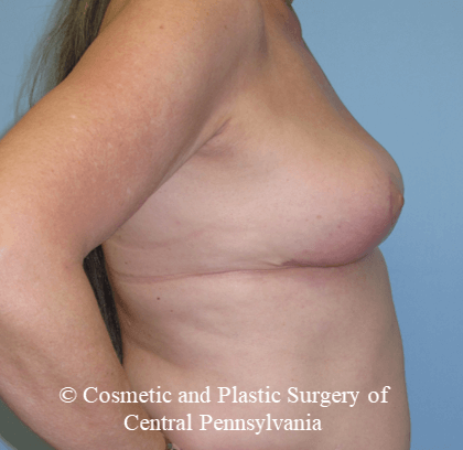 Breast Lift (Mastopexy) After