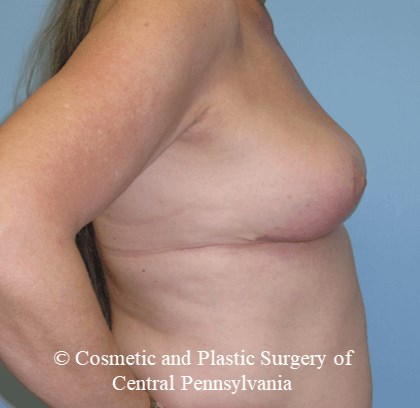 Breast Lift (Mastopexy) After