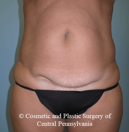 Mini Tummy Tuck Before