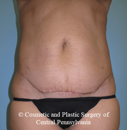 Mini Tummy Tuck After