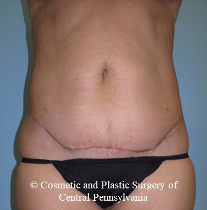 Mini Tummy Tuck After