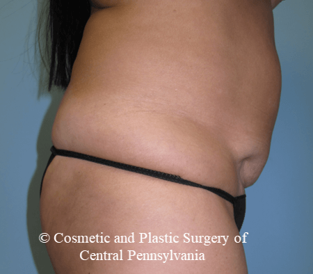 Mini Tummy Tuck Before