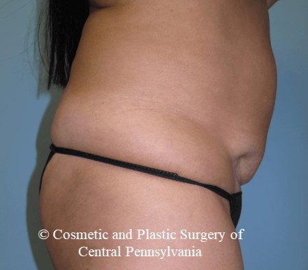 Mini Tummy Tuck Before