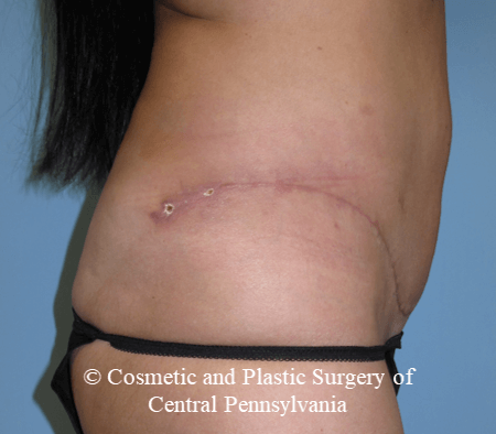 Mini Tummy Tuck After