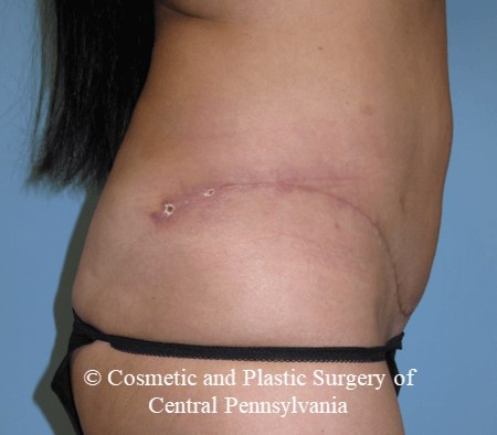 Mini Tummy Tuck After