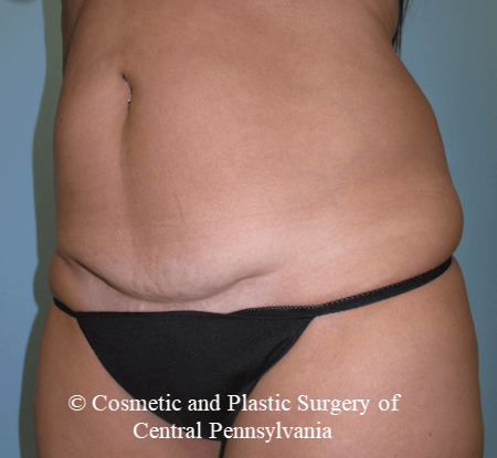 Mini Tummy Tuck Before