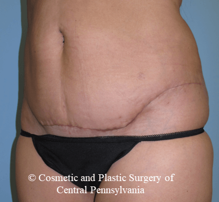Mini Tummy Tuck After