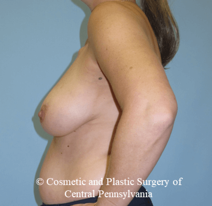 Breast Reconstruction Before