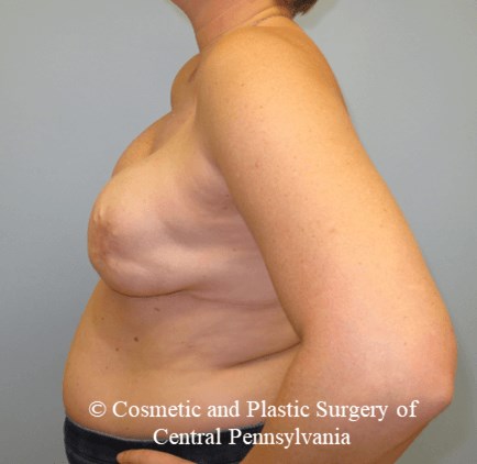 Breast Reconstruction After