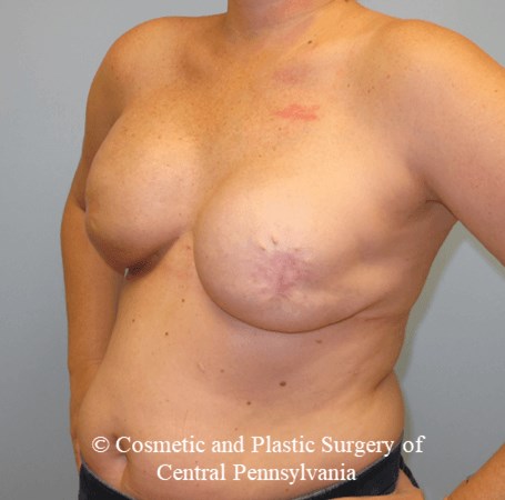 Breast Reconstruction After